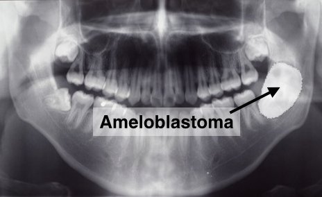 рентген амелобластомы