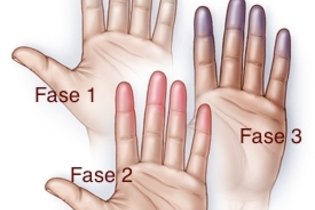 Изменение цвета рук при болезни Бюргера