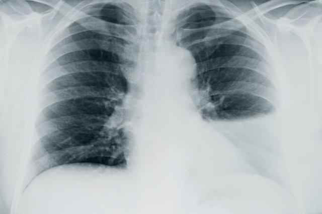 Рентгенограмма с плевральным выпотом слева